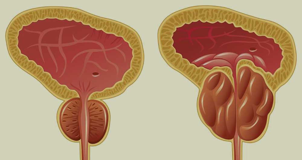 benigna hiperplazija prostate